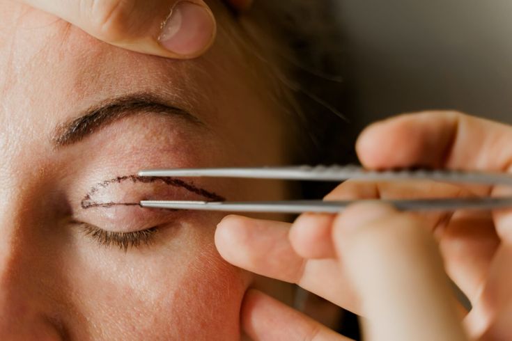 Blepharoplasty Orlando, FL Eyelid Surgery by…