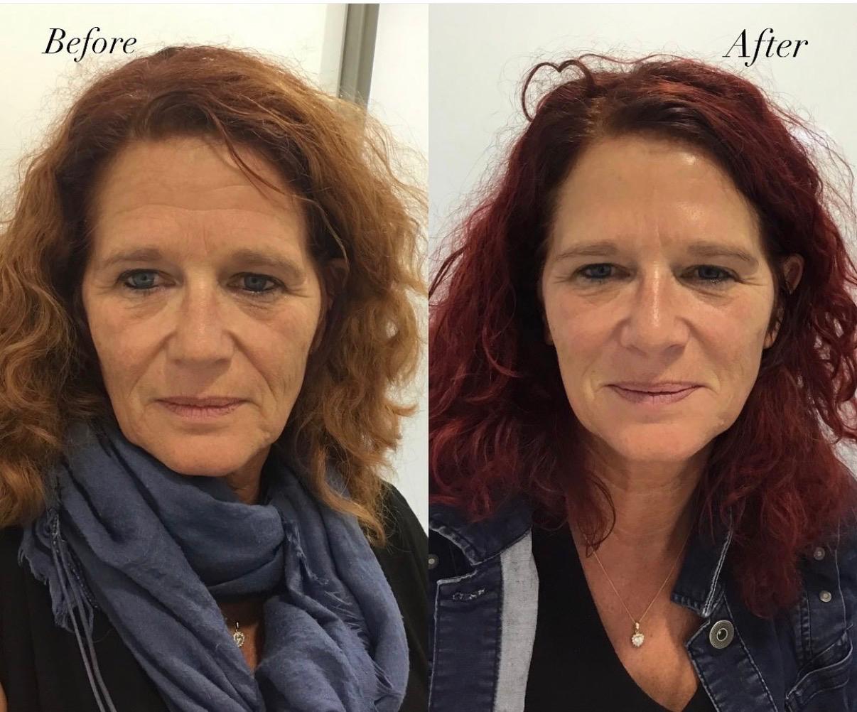 Botoxbehandeling in de behandelkamer van DM Aesthetics